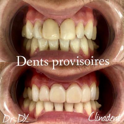 couronnes provisoires dentiste paris 2