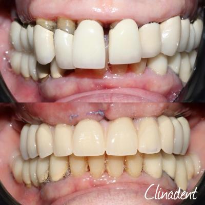 prothèse dentaire complète sur 6 implant clinadent paris 2