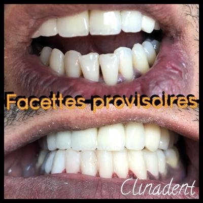 Réalisation de facettes dentaires au Centre Clinadent Paris 2 ème